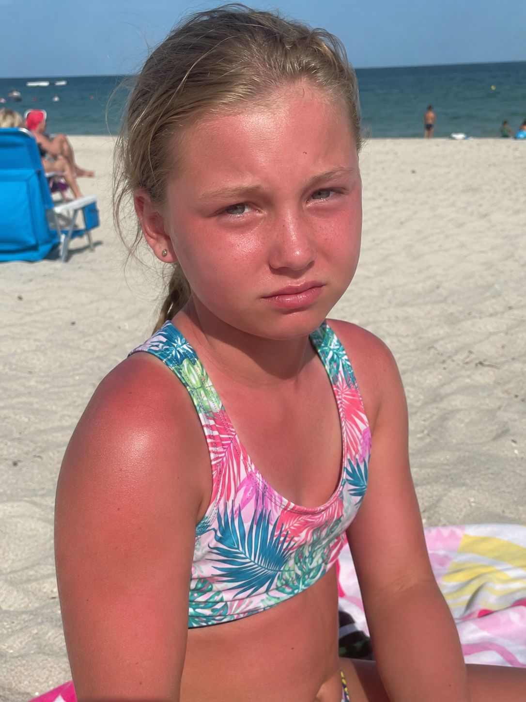 Sunburn